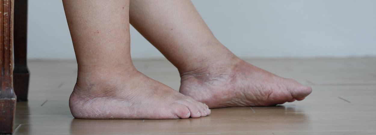 Otoky nohou můžou značit nefunkčnost lymfatického systému, ale být i znakem žilní nedostatečnosti. Nezbytné je důkladné vyšetření.