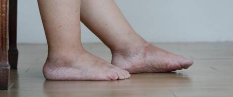 Otoky nohou můžou značit nefunkčnost lymfatického systému, ale být i znakem žilní nedostatečnosti. Nezbytné je důkladné vyšetření.